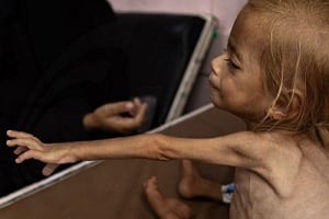 Tα υποσιτισμένα παιδιά στη Γάζα τριπλασιάστηκαν από τον Μάρτιο, λέει η UNRWA
